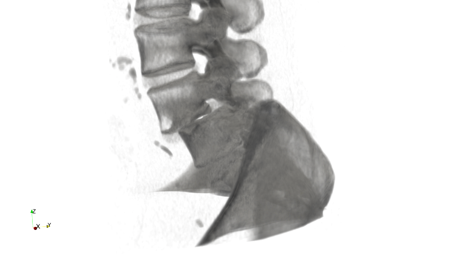 dislocation
